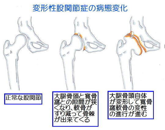 変形性股関節症 - 鍼灸院・整体 はり・きゅう 快気院（十勝：幕別町