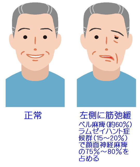 顔面麻痺 - 鍼灸院・整体 はり・きゅう 快気院（十勝：幕別町・帯広市等）